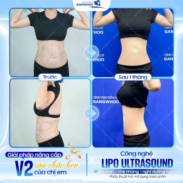 Giải pháp nâng cấp vòng 2 săn chắc hơn được nhiều chị em tin chọn là giảm mỡ với công nghệ Lipo Ultrasound