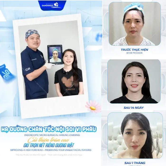 Hạ đường chân tóc nội soi vi phẫu tái định hình đường tóc chuẩn tỷ lệ cho cả gương mặt