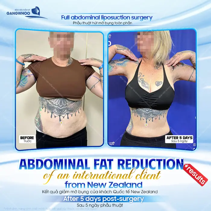 Kết quả giảm mỡ bụng của khách Quốc tế New Zealand sau 5 ngày phẫu thuật đã khác biệt thấy rõ