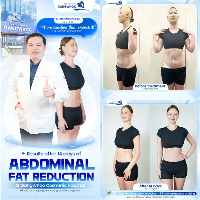 Kết quả sau 14 ngày giảm mỡ công nghệ Liop Ultrasound khách hàng hài lòng về kết quả sau 14 ngày thực hiện