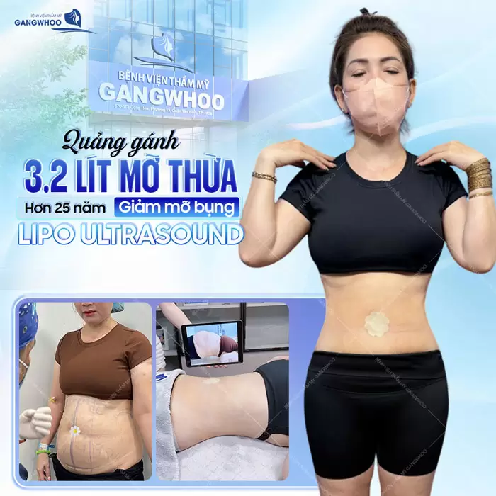 Hút Mỡ Bụng Có An Toàn Không? 5 Điều Cần Lưu Ý Khi Hút Mỡ 4 Giảm mỡ bụng công nghệ Lipo Ultrasound quảng 3.2 lít mỡ thừa một cách hiệu quả và an toàn