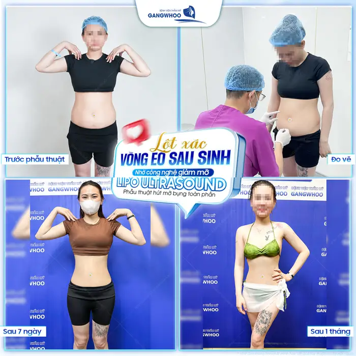 Lột xác vòng eo sau sinh nhờ công nghệ giảm mỡ Lipo Ultrasound hiện đại sau 1 tháng đã tự tin khoe eo thon gọn 