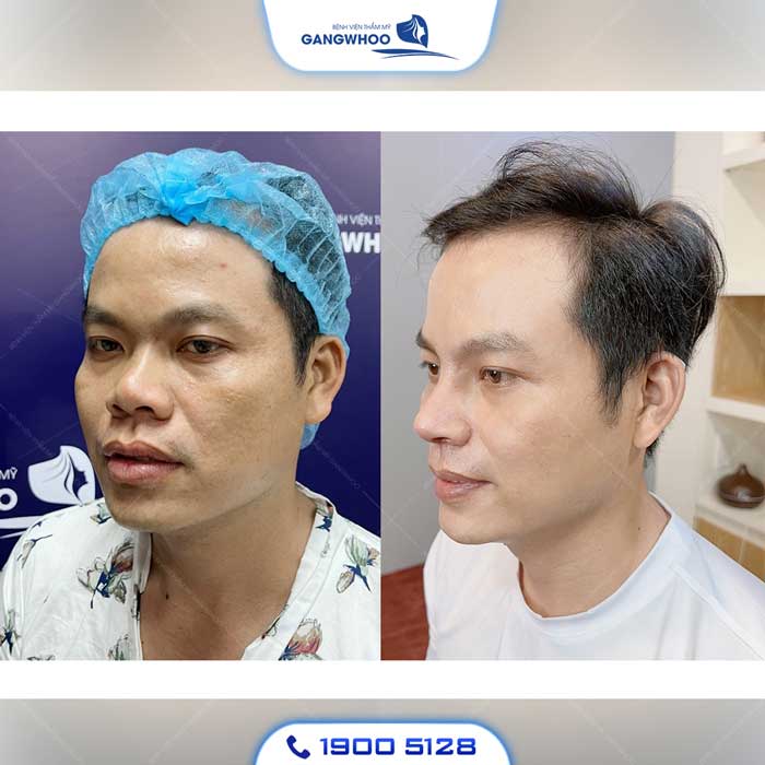 nâng mũi l line nam