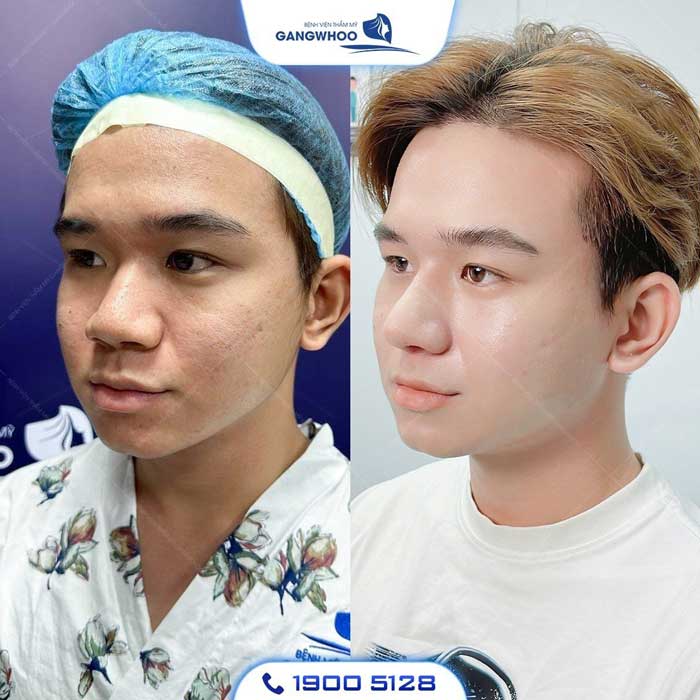 nâng mũi l line nam