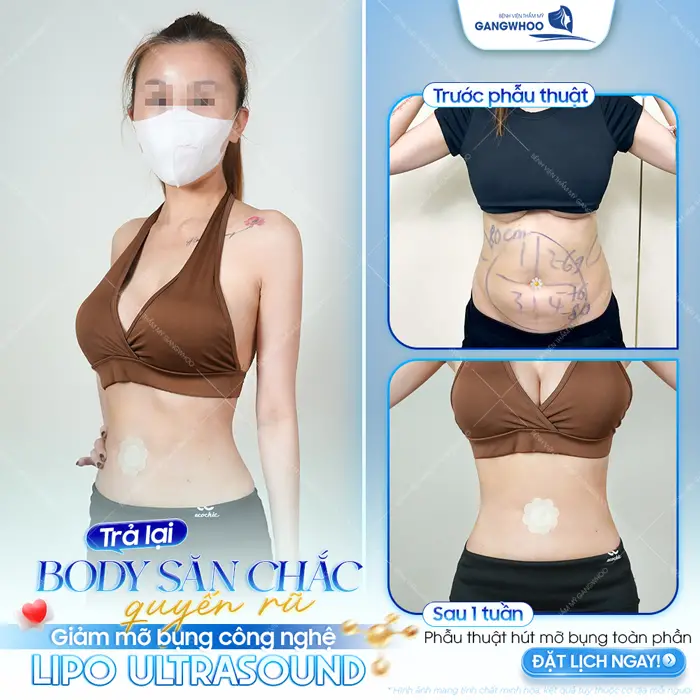 Trả lại body săn chắc quyến rũ sau 1 tuần giảm mỡ bụng công nghệ Lipo Ultrasound