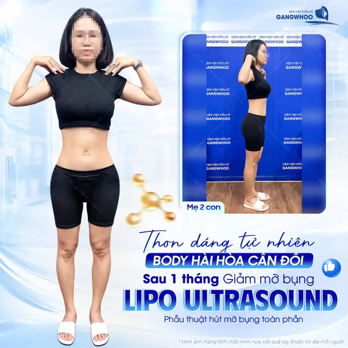 Thon dáng tự nhiên body hài hòa sau 1 tháng giảm mỡ bụng Lipo Ultrasound mẹ 2 con đẹp ngỡ ngàng