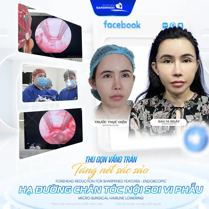 Thu gọn vầng trán tăng nét đẹp sắc sảo gương mặt thêm hài hòa, tự nhiên và cuốn hút hơn