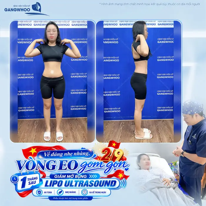 Hút Mỡ Bụng Có An Toàn Không? 5 Điều Cần Lưu Ý Khi Hút Mỡ 6 Về dáng nhẹ nhàng vòng eo gọn lại sau 1 tháng giảm mỡbụng công nghệ Lipo Ultrasound eo thon đẹp gọn