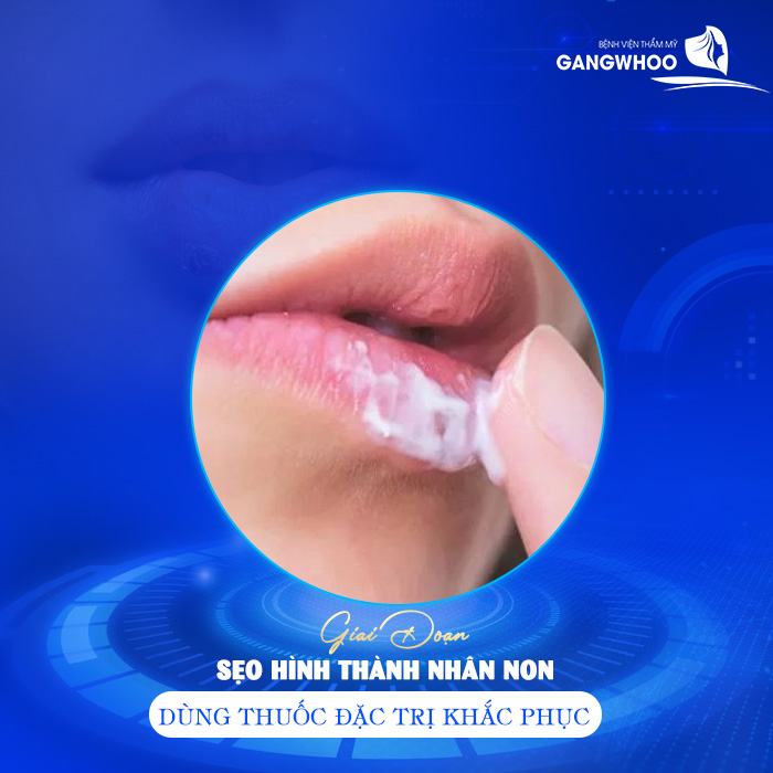 Phun Môi Bị Sẹo Phải Làm Sao? Tổng Hợp 4 Cách Trị Sẹo Nhanh Lành 9 Phun Môi Bị Sẹo Phải Làm Sao