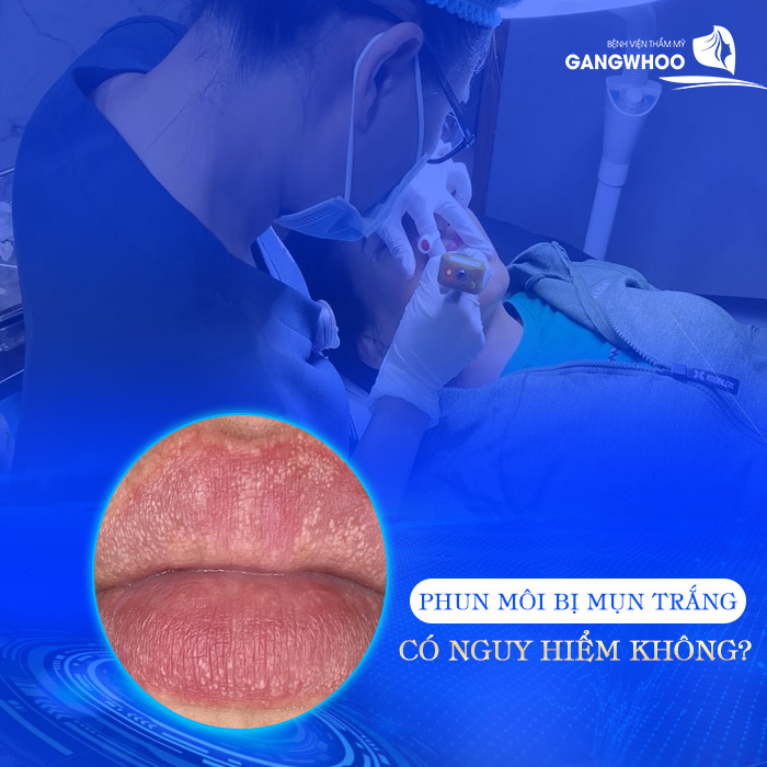 5 Nguyên Nhân Phun Môi Bị Nổi Mụn Trắng Và Mẹo Khắc Phục Hiệu Quả 9 Phun Môi Bị Nổi Mụn Trắng