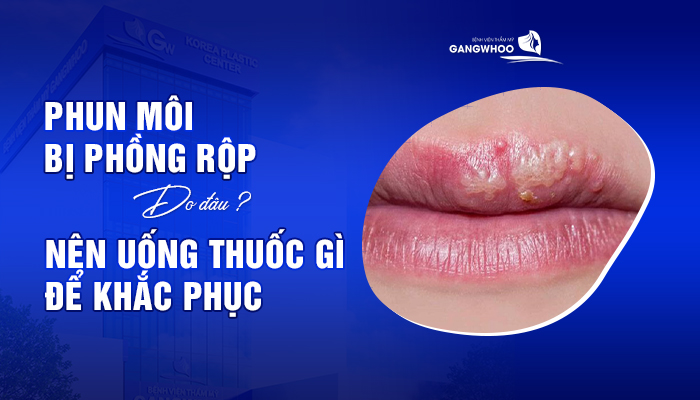 phun moi bi phong rop