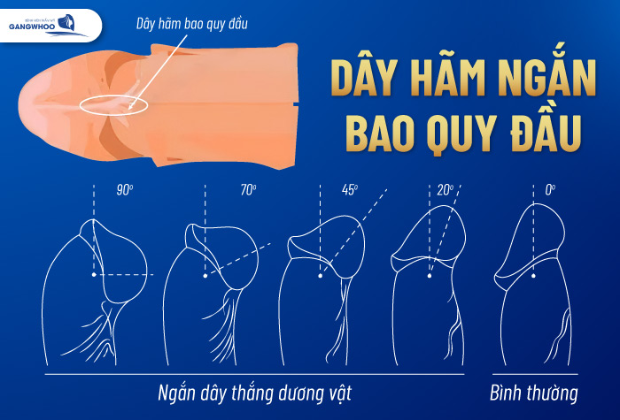 Điều Trị Dây Hãm Ngắn 