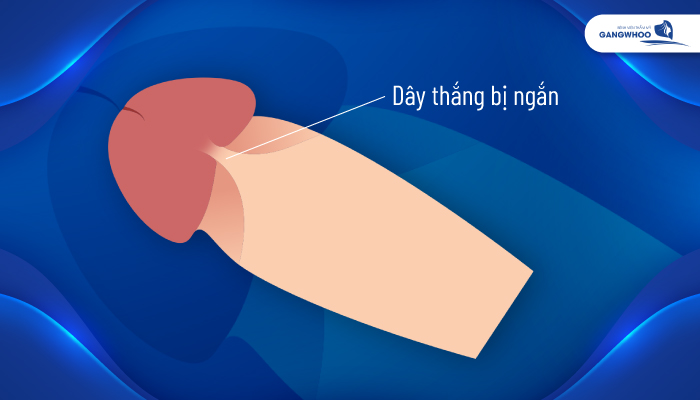 Điều Trị Dây Hãm Ngắn 
