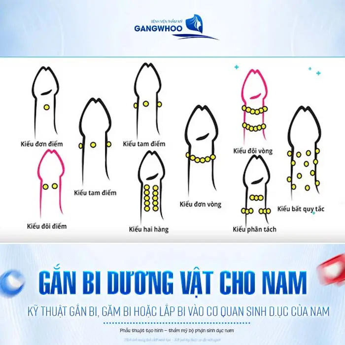 Gắn Bi Dương Vật Cho Nam Là Gì? Chi Phí Bao Nhiêu?