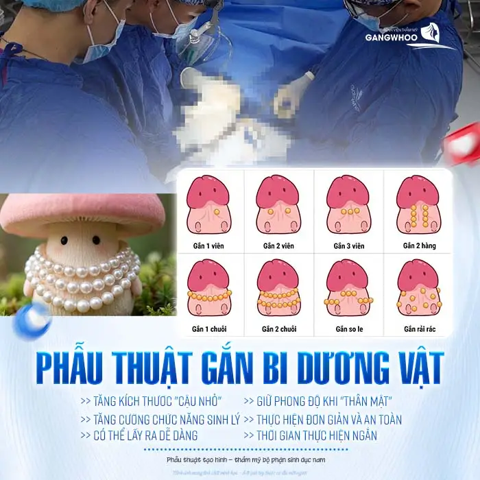 Gắn Bi Dương Vật Cho Nam Là Gì? Chi Phí Bao Nhiêu?