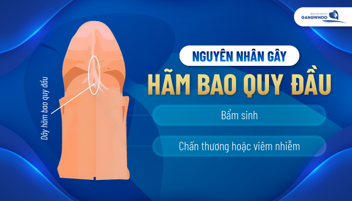 Điều Trị Dây Hãm Ngắn 