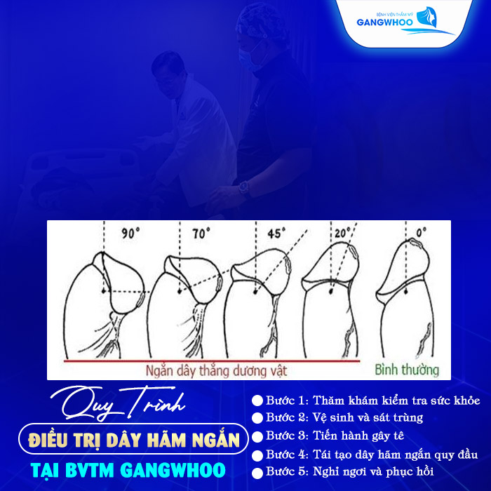 Điều Trị Dây Hãm Ngắn