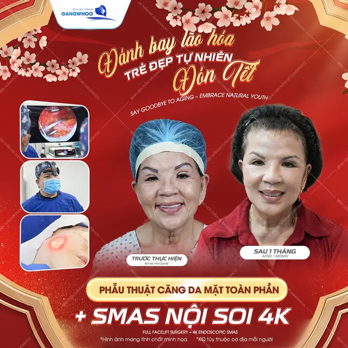 Căng Da Mặt Bây Giờ Có Kịp Tết Không? Tiết Lộ 3 Lý Do Nên Làm 4 Đánh bay lão hóa trẻ đẹp tự nhiên đón Tết trẻ hơn, đẹp hơn và tự tin hơn