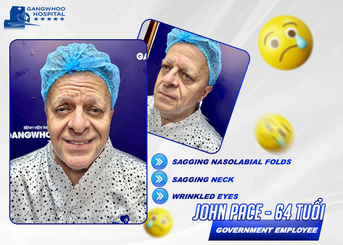 SMAS Facelift