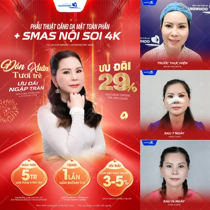 Căng Da Mặt Bây Giờ Có Kịp Tết Không? Tiết Lộ 3 Lý Do Nên Làm 7 Phẫu thuật căng da mặt toàn phần Smas nội soi 4K đón xuân tươi trẻ ưu đãi ngập tràn