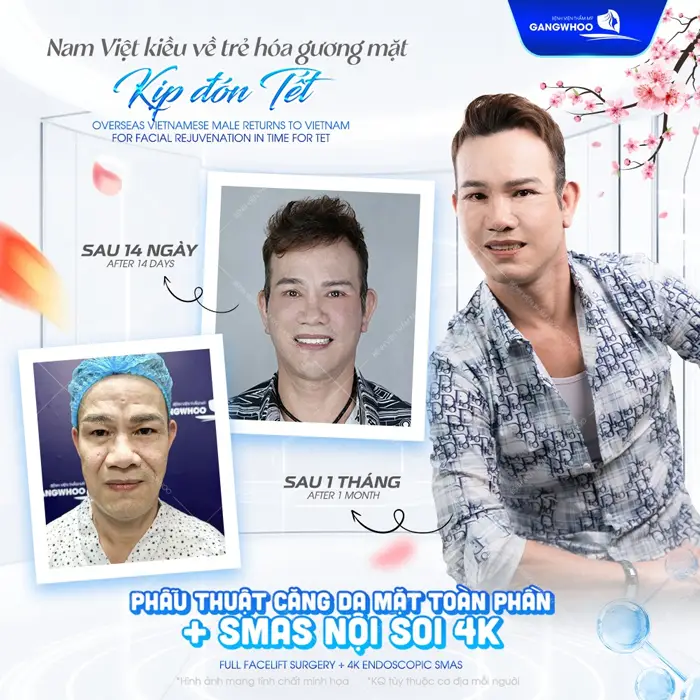 Căng Da Mặt Bây Giờ Có Kịp Tết Không? Tiết Lộ 3 Lý Do Nên Làm 2 Việt Kiều Mỹ về Gangwhoo trẻ hóa gương mặt kịp đệp đón tết kết quả hồi phục rõ rệt qua từng ngày