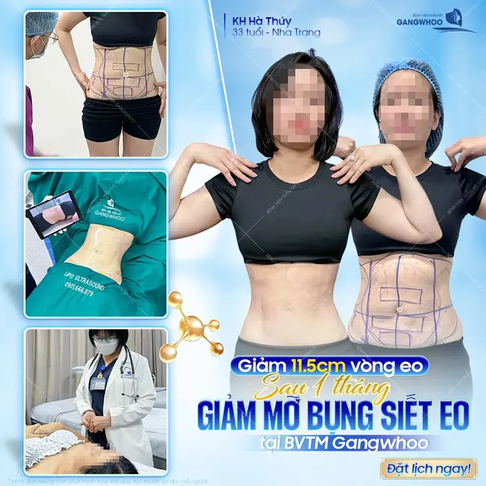 Giảm gần 12cm vòng eo sau 1 tháng giảm mỡ bụng siết eo tại BVTM Gangwhoo