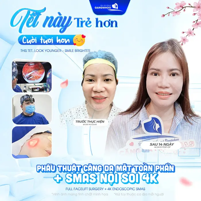 Căng Da Mặt Bây Giờ Có Kịp Tết Không? Tiết Lộ 3 Lý Do Nên Làm 8 Tết này trẻ hơn, cười tươi hơn sau phẫu thuật căng da mặt toàn phần