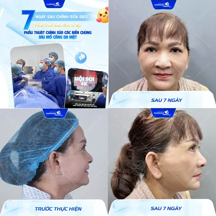 Kết quả sau 7 ngày sửa sẹo căng da mặt cho cô khách bị biến chứng sẹo xấu sau nhiều năm thực hiện