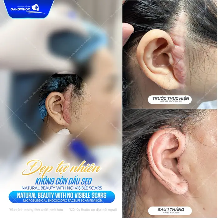 Kết quả đẹp tự nhiên không còn dấu sẹo sau 6 tháng đã hoàn toàn thay đổi 