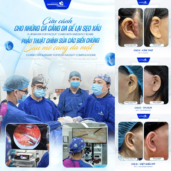 Cứu cánh cho những ca căng da để lại sẹo xấu sau phẫu thuật chỉnh sửa các biến chứng sau mổ căng da mặt 