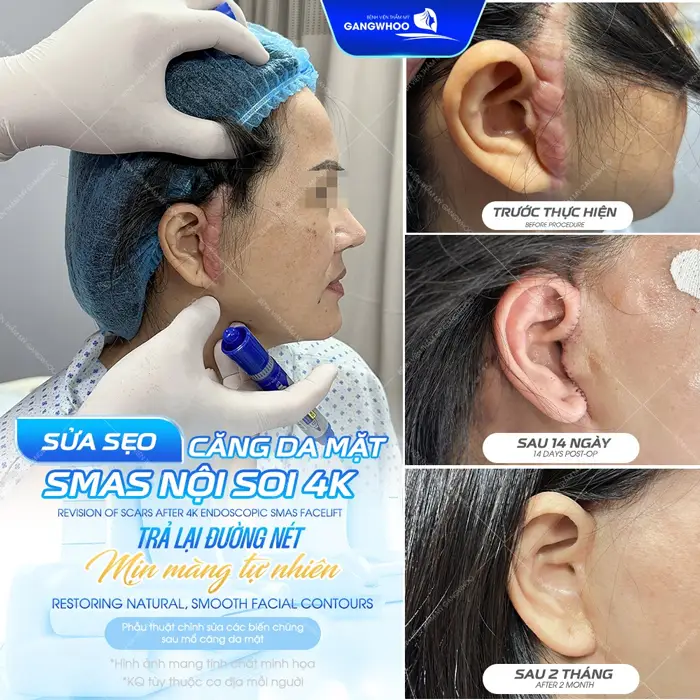 Sửa sẹo căng da mặt trả lại đường nét mịn màng và tự nhiên cho khuôn mặt