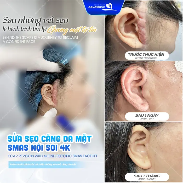 Sau những vết sẹo là hành trình tìm lại gương mặt tự tin sau 1 tháng những vết sẹo cũ đã hoàn toàn biến mất