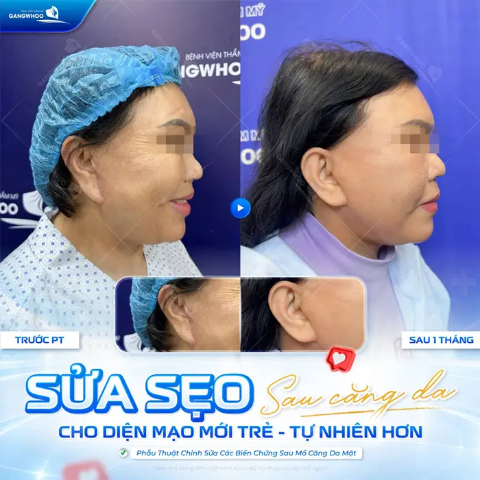 Sửa sẹo sau căng da mặt cho diện mạo mới tươi trẻ và tự nhiên hơn 