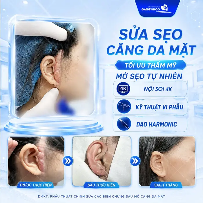 Sửa sẹo căng da mặ tối ưu thẩm mỹ mờ sẹo tự nhiên với công nghệ hiện đại