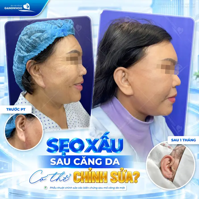 Sửa sẹo xấu sau căng da mặt khôi phục đường nét phẳng mịn cho căng đẹp cho diện mạo tổng thể