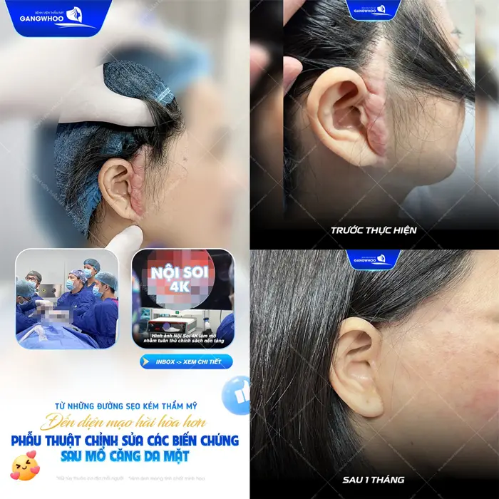 Phẫu thuật chỉnh sửa biến chứng sau mổ căng da mặt tạm biệt sẹo lồi, sẹo xấu khôi phục diện mạo tự tin