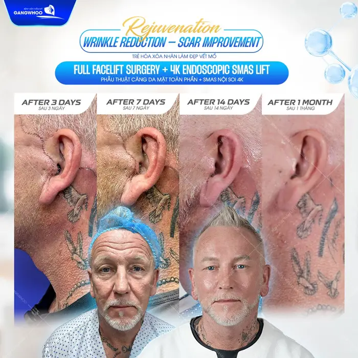 Trẻ hóa xóa nhăn không lo sẹo xấu sau phẫu thuật căng da mặt ứng dụng công nghệ hiện đại tại BVTM Gangwhoo