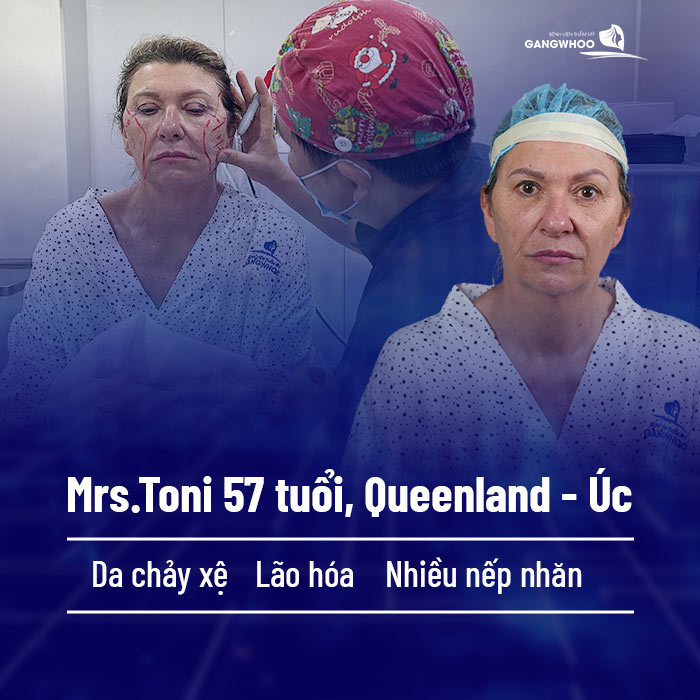 tinh trang da mat cua mrs toni