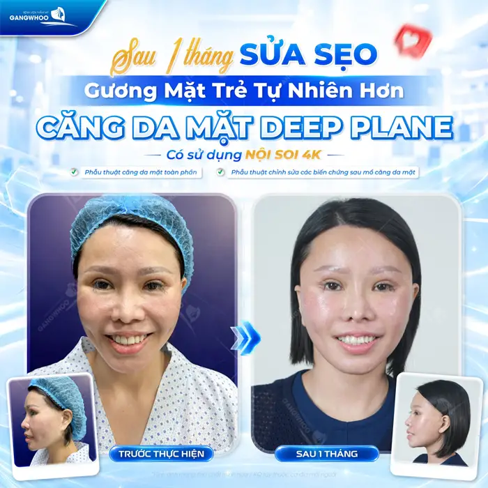Kết quả sau 1 tháng sửa sẹo gương mặt trẻ đẹp tự nhiên hơn 
