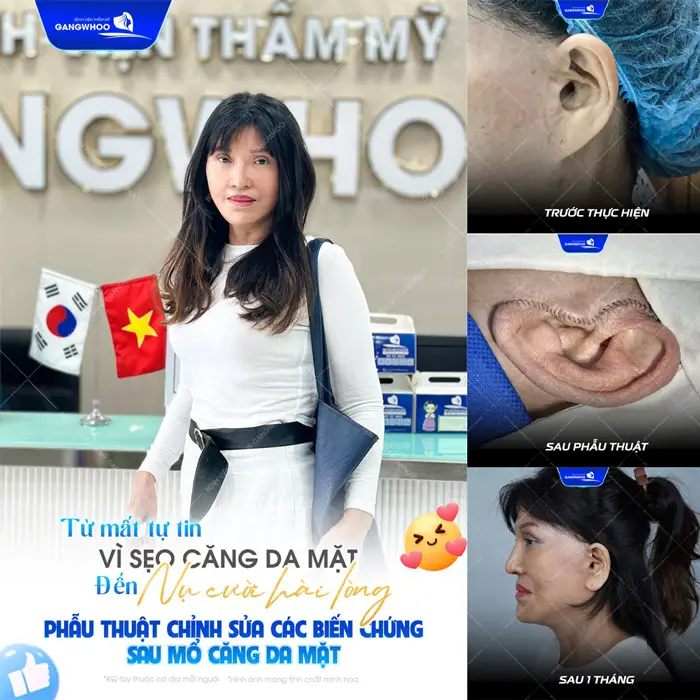 Nguyên Nhân Và Phương Pháp Khắc Phục Sẹo Căng Da Mặt 1 Từ mất tự tin vì sẹo căng da mặt đến nụ cười hài hòa sau phẫu thuật chỉnh sửa các biến chứng sau mổ căng da mặt