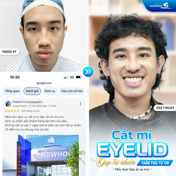 Giáo viên Úc chọn hành trình làm đẹp trẻ hóa tại bệnh viện thẩm mỹ Gangwhoo và diện mạo sau 14 ngày ai cũng ngỡ ngàng