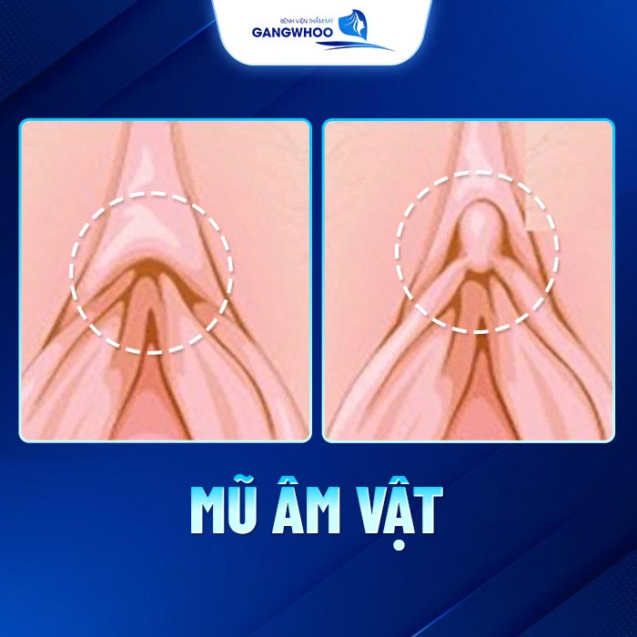 Chỉnh Mũ Âm Vật Là Gì? Tại Sao Phụ Nữ Nên Thực Hiện Sớm 10 Chỉnh Mũ Âm Vật