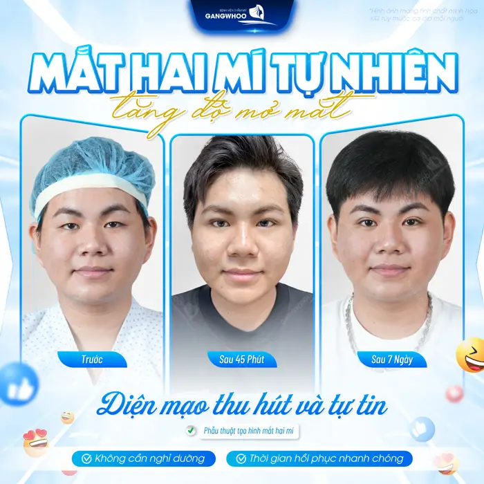 Mắt 2 mí tự nhiên tăng độ mở m ắt diện mạo thu hút và tự tin cho phái mạnh