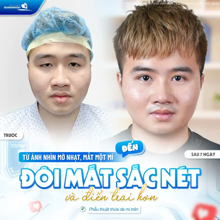 Từ ánh nhìn mờ nhạt đến đôi mặt 2 mí đẹp sắc nét với diện mạo điển trai hơn thấy rõ