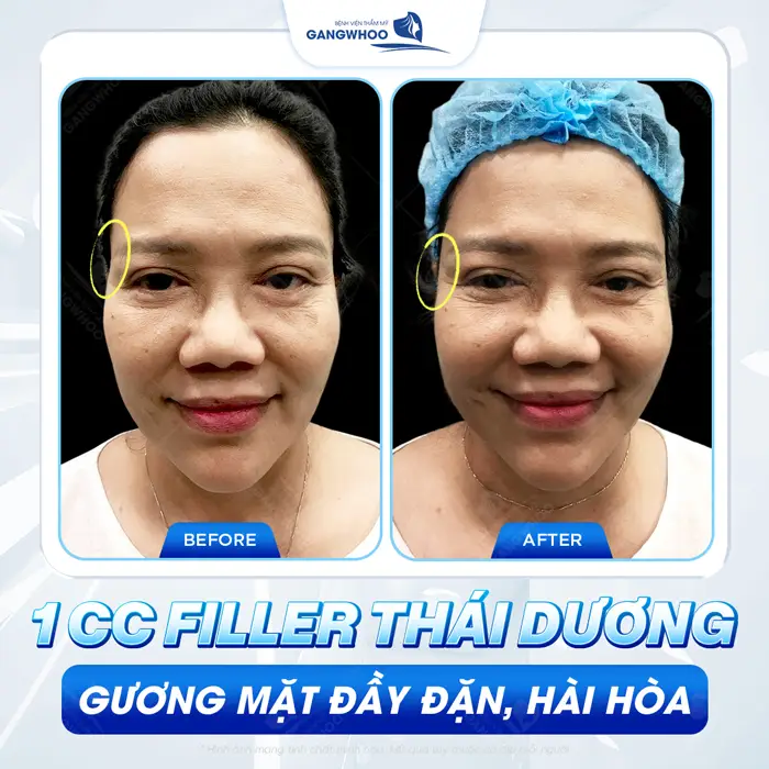 Tiêm Filler thái dương gương mặt đầy đặn, hài hòa và cân đối ngay sau thực hiện 
