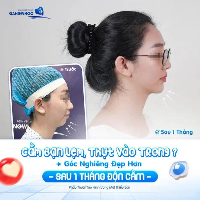 Cằm lẹm, ngắn sau 1 tháng độn cằm góc nghiêng đẹp thanh thoát và gương mặt thêm hài hòa, cân đối