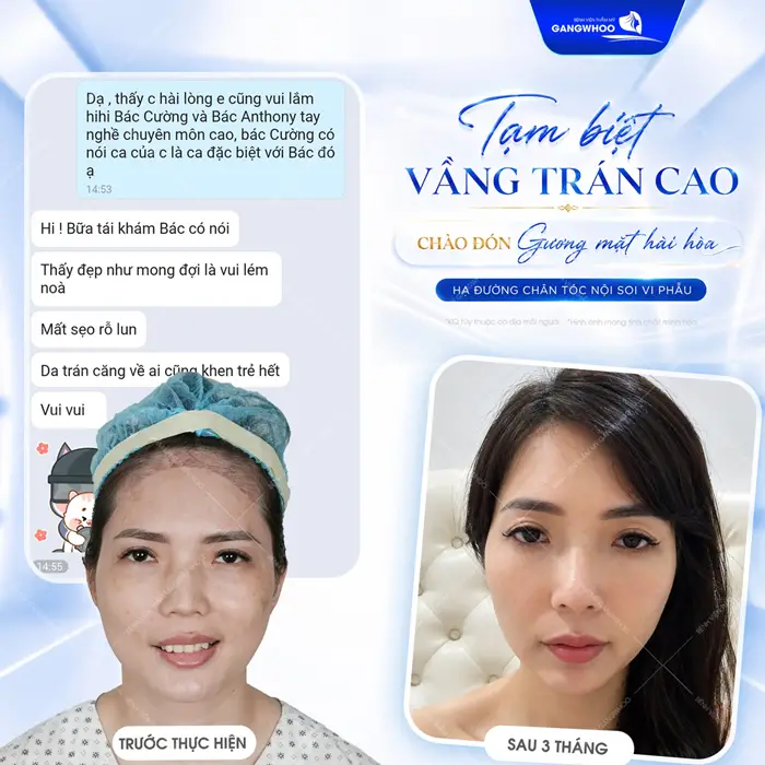 Tạm biệt vầng trán cao chào đón gương mặt hài hòa sau hạ đường chân tóc nội soi 