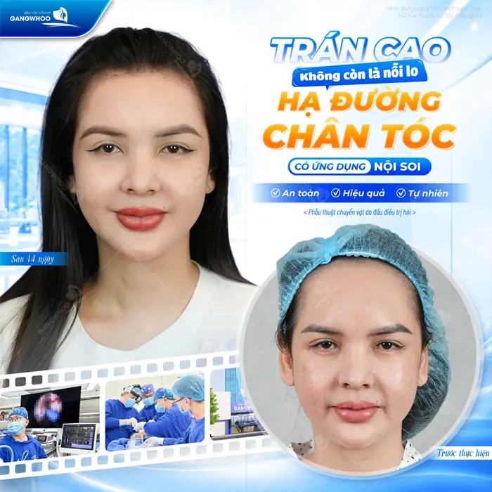 Hạ Đường Chân Tóc Có Nguy Hiểm Không? Những Yếu Tố An Toàn 4 Hạ đường chân tóc có ứng dụng nội soi giải pháp an toàn, hiệu quả và đẹp tự nhiên dài lâu