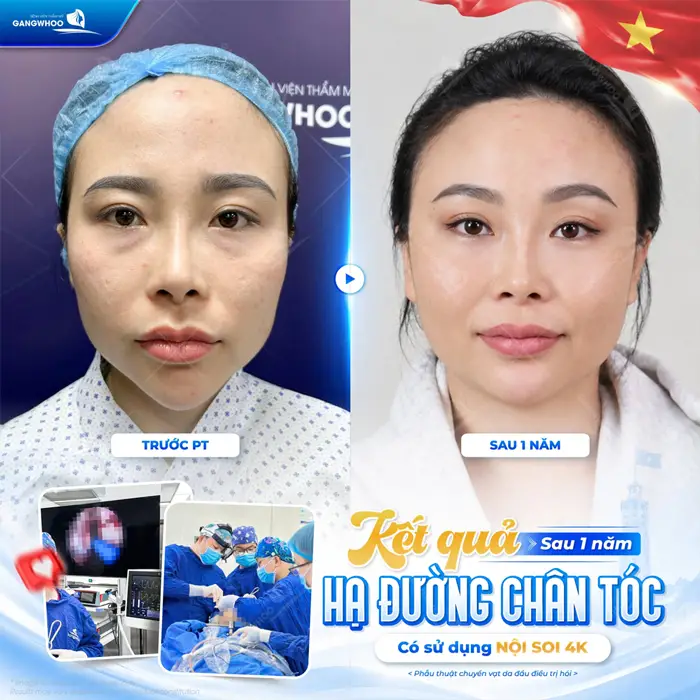 Chi Phí Hạ Đường Chân Tóc Bao Nhiêu Tiền? Bảng Giá 2026 4 Kết quả sau 1 năm hạ đường chân tóc có sử dụng công nghệ nội soi 4K