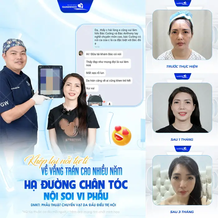 Khép lạ nỗi tự ti về vầng trán cao nhiều năm với công nghệ nội soi vi phẫu đem lại sự thay đổi vượt ngoài mong đợi